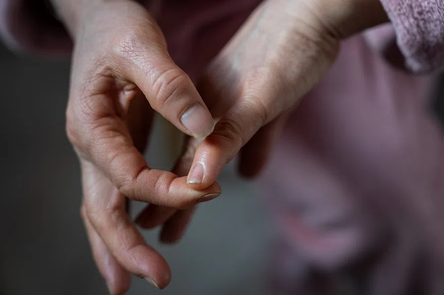 Long-term domestic work has led to Sister Chen’s finger joints to become enlarged and misshapen.