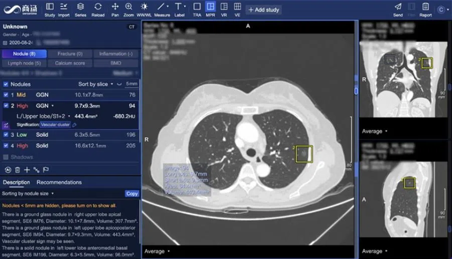 A screen showing SenseTime’s AI-powered lung cancer screening system. (SenseTime website)