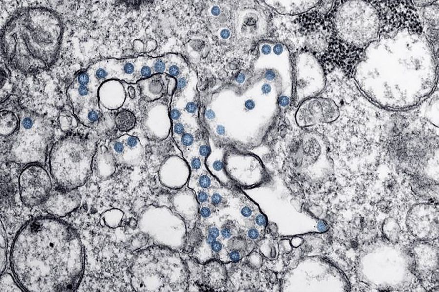 This handout illustration image obtained on 27 February 2020 courtesy of the Centers for Disease Control and Prevention (CDC) shows a transmission electron microscopic image of an isolate from the first US case of Covid-19, with the spherical viral particles, colourised blue, containing cross-sections through the viral genome, seen as black dots. (AFP Photo/Centers for Disease Control and Prevention/Hannah A Bullock and Azaibi Tamin/Handout)