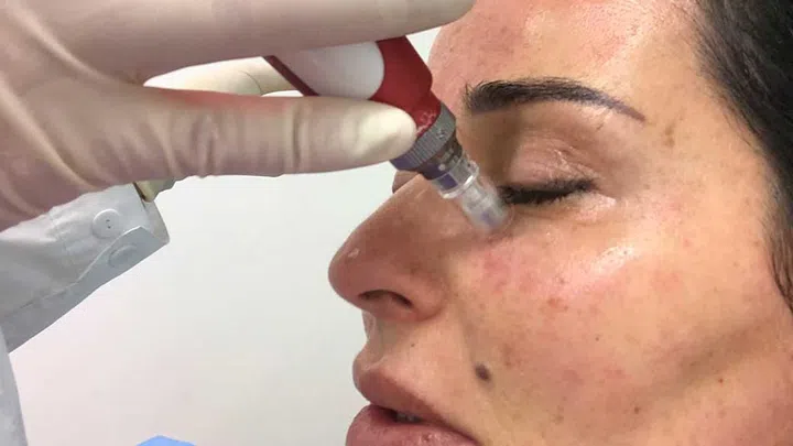 Skin needling is where the upper dermal layer is punctured by tiny needles.