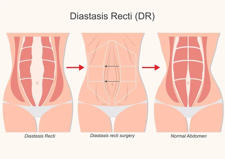 diastasis recti after pregnancy