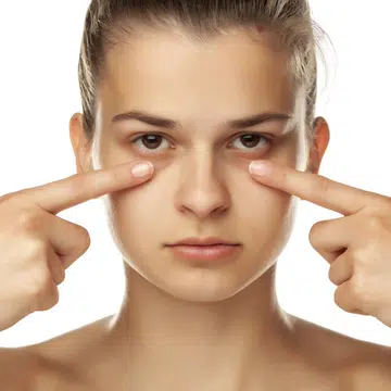 Dark eye circles
