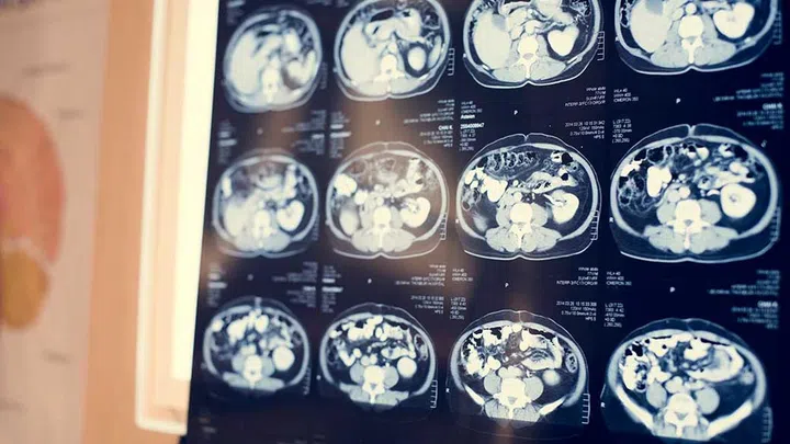 Remarkably, fMRI (functional magnetic resonance imaging) showed that the adults in the program improved their cognitions over a span of two years and even reversed declines in brain volume in regions vulnerable to dementia (e.g. the hippocampus).