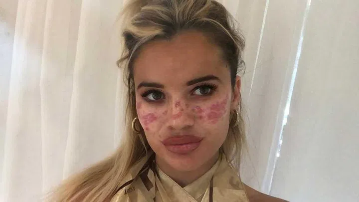 Tilly took to her Instagram account to recount the happenings of her freckle affair.