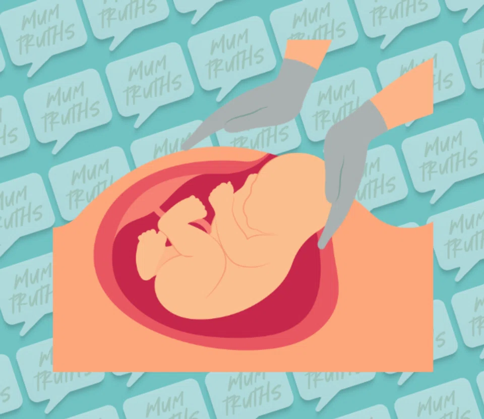 elective c-section singapore mum pov no regrets
