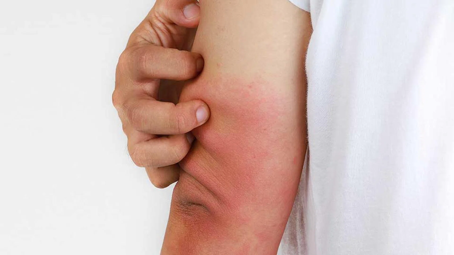 A complete guide to eczema for both beginners and long-term patients by Dr John O’Shea and Jason Humphries, founders of Good Pharma Dermatology and Suu Balm