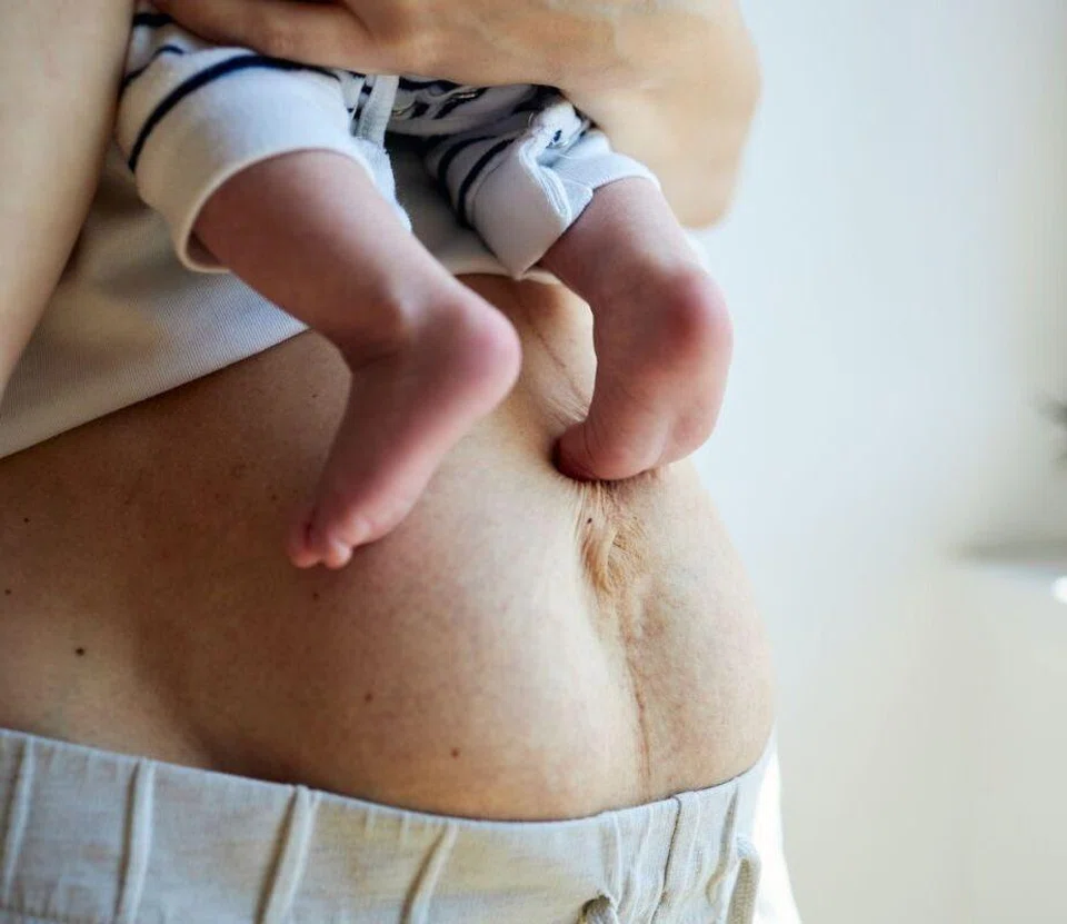 diastasis recti after pregnancy