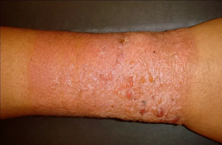 Contact dermatitis is caused by contact with somethign that causes an allergic reaction - it can be confused with eczema, which is why it's important to see a doctor for correct treatment.