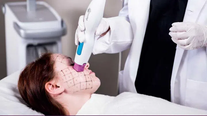 Thermal FLX is a non-surgical eyelid lift. It reduces signs of premature ageing around the delicate eye area.