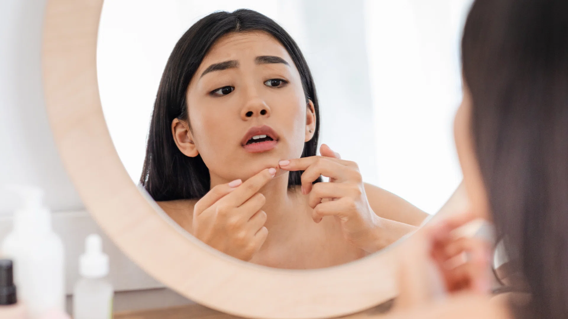 Cystic acne pimple pores