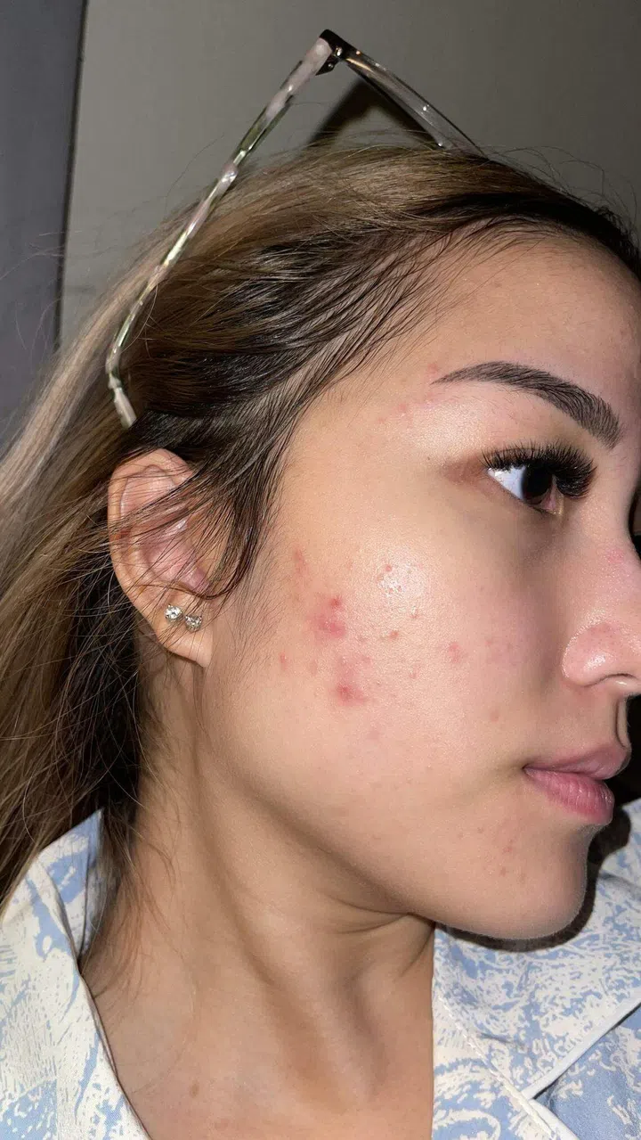 Ms Shina Toh says piling on more make-up only exacerbated her acne. PHOTO: SHINA TOH