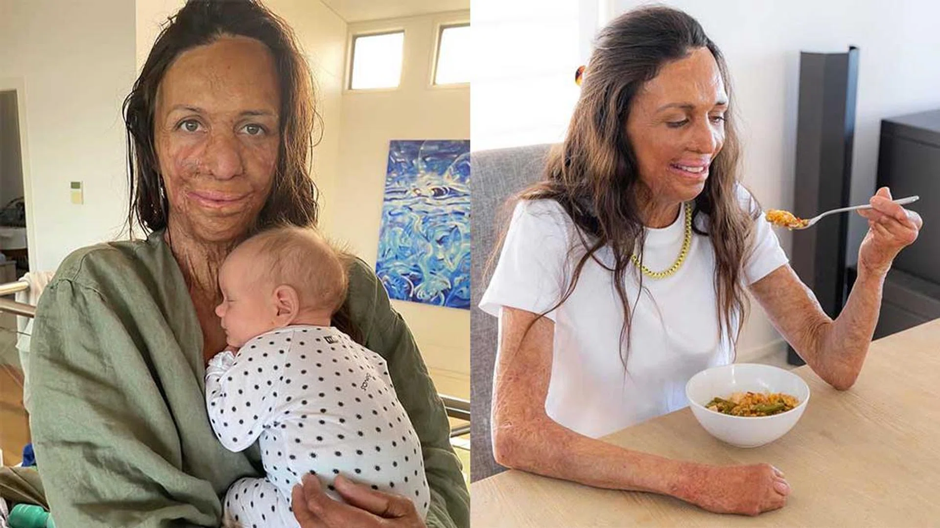 Australian mother-of-two, Turia Pitt, suffered 65 per cent burns to her body. Today, she's an author and coach
