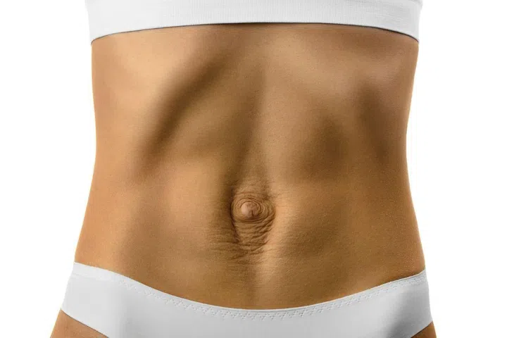 diastasis recti after pregnancy