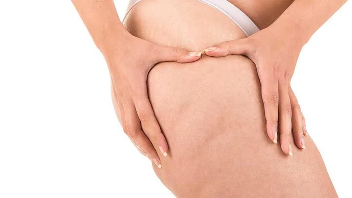 Does Dry Brushing Remove Cellulite?