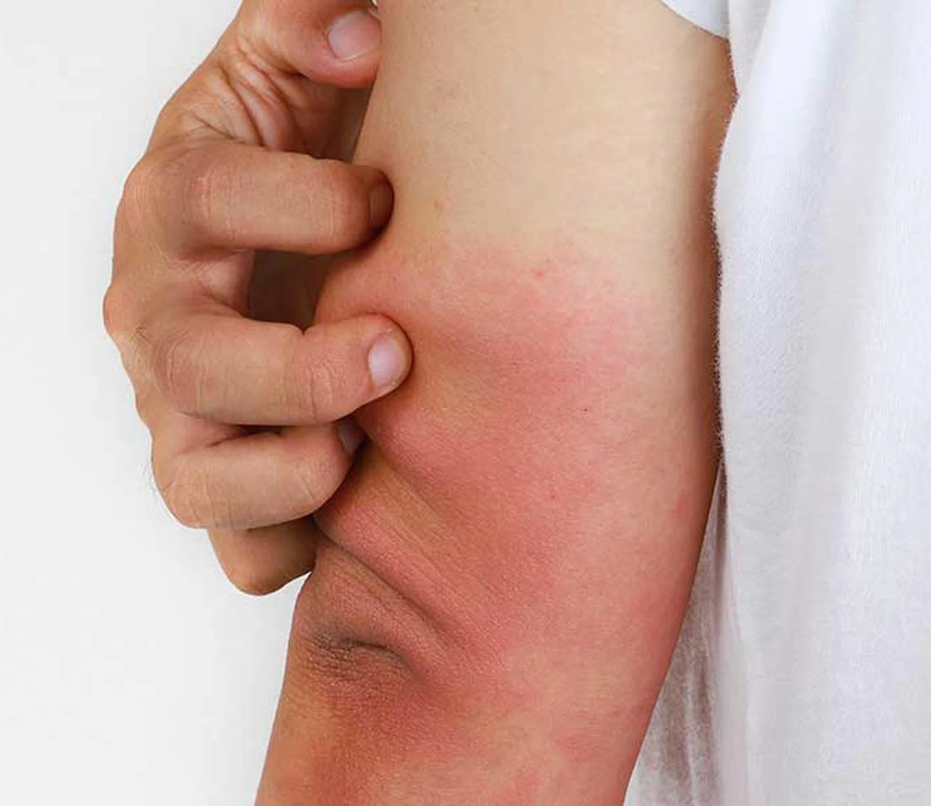 A complete guide to eczema for both beginners and long-term patients by Dr John O’Shea and Jason Humphries, founders of Good Pharma Dermatology and Suu Balm