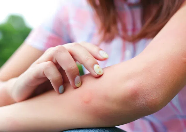 Arm of gilr is bitten by the mosquito and get bumps on her skin  in the summer 