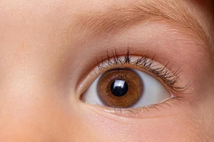 Contact lenses are being used in suitable children to slow the progression of their myopia