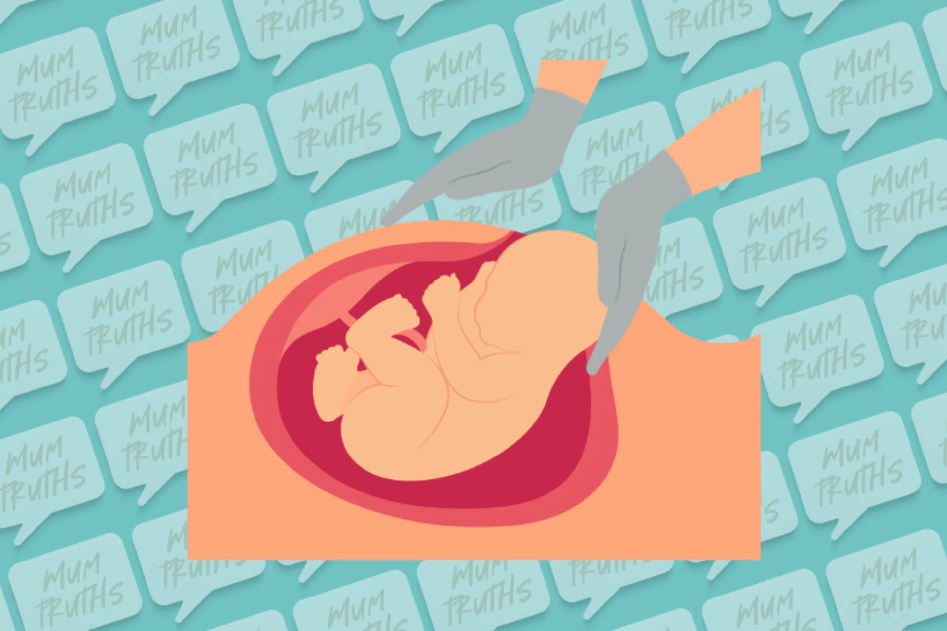 elective c-section singapore mum pov no regrets