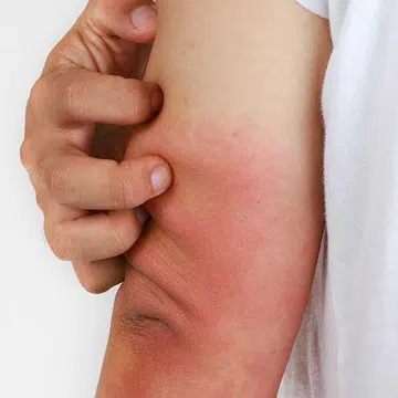 A complete guide to eczema for both beginners and long-term patients by Dr John O’Shea and Jason Humphries, founders of Good Pharma Dermatology and Suu Balm