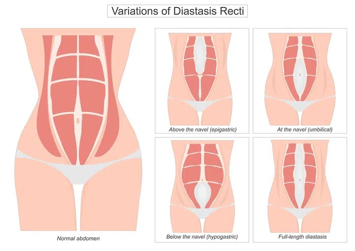 diastasis recti after pregnancy