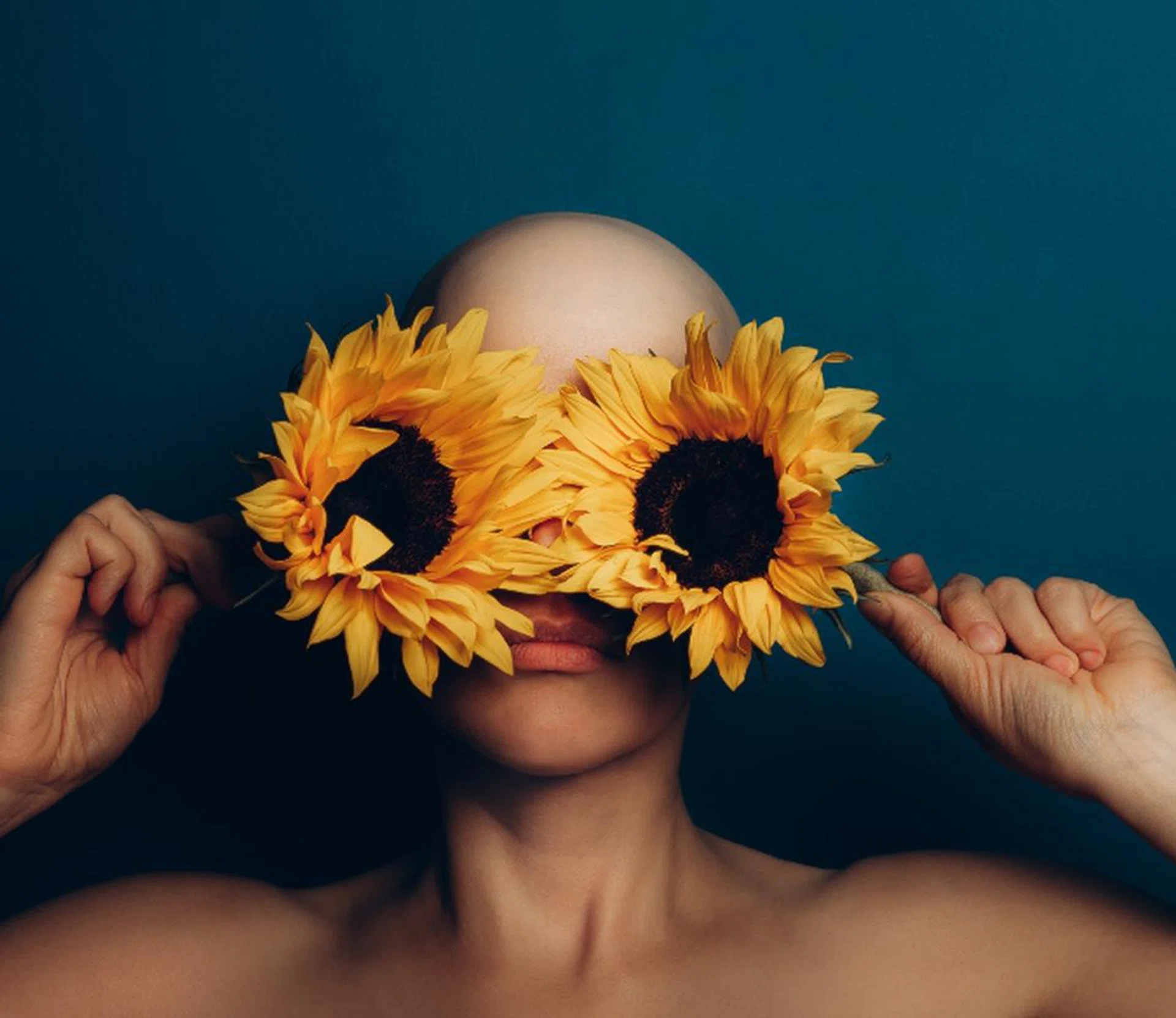 Alopecia Areata