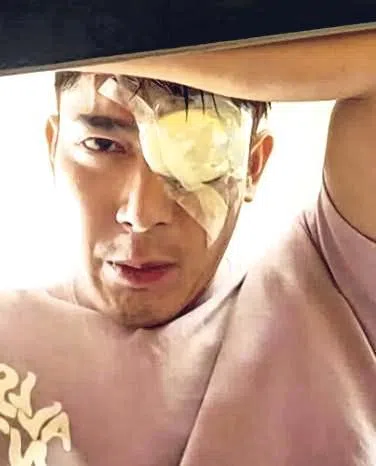 黄俊雄日前右眼视网膜脱落。（取自艺人脸书）