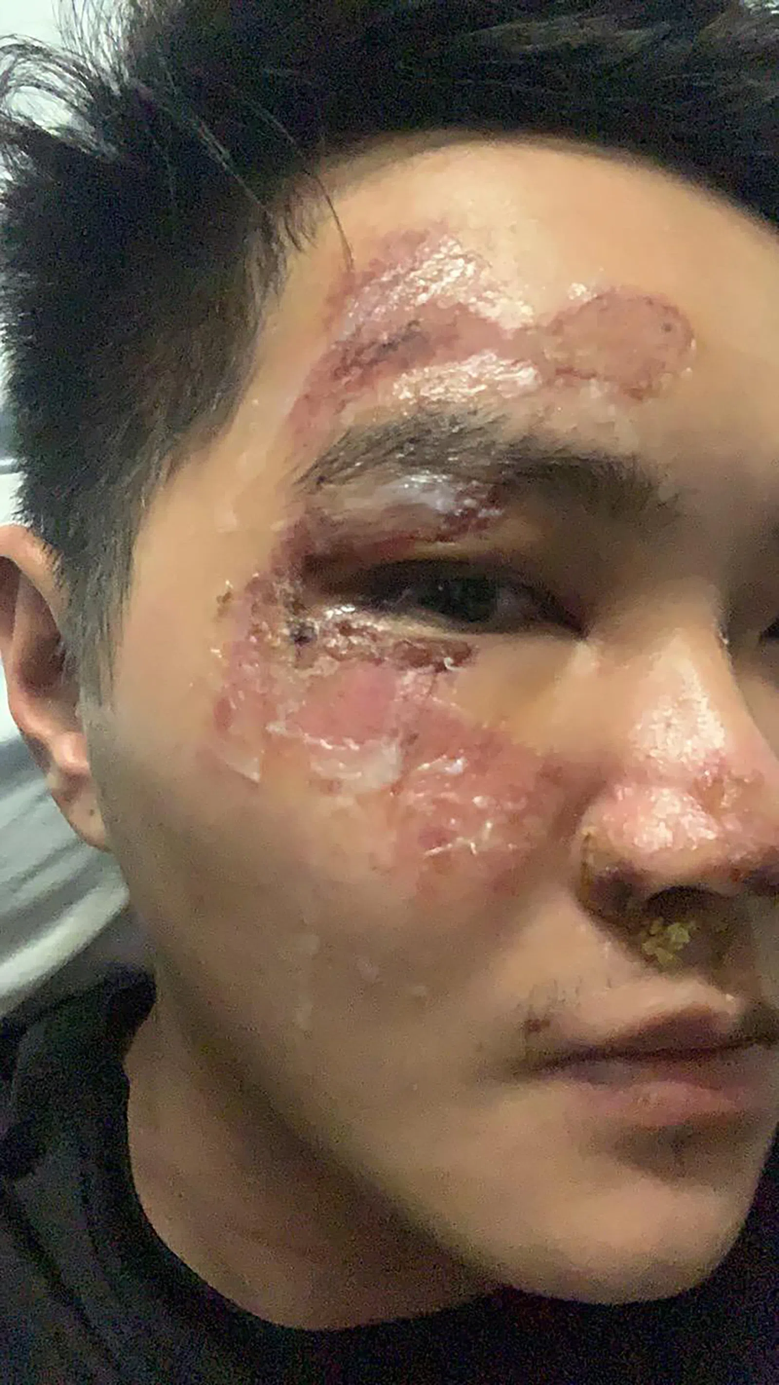 伦晨曦的脸部留下明显的伤痕。（受访者提供）