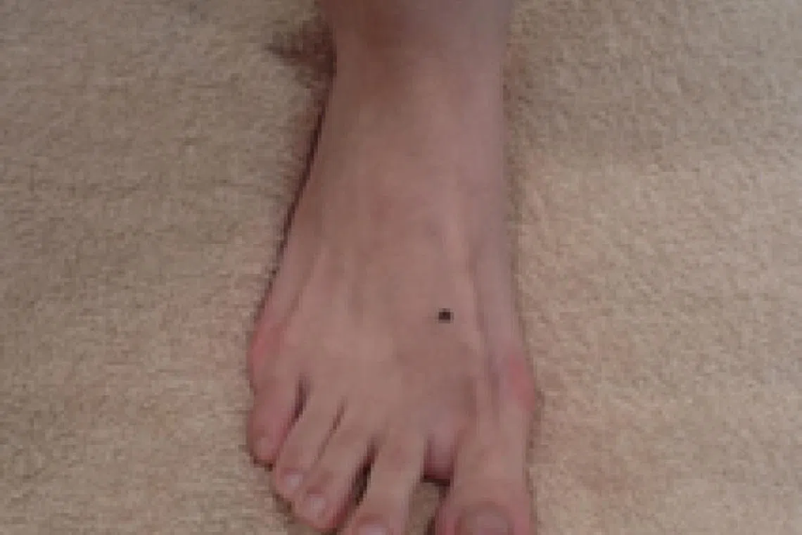 太冲穴：肝经的穴位，位于足背大趾和二趾指缝之间的凹陷处。（档案照）