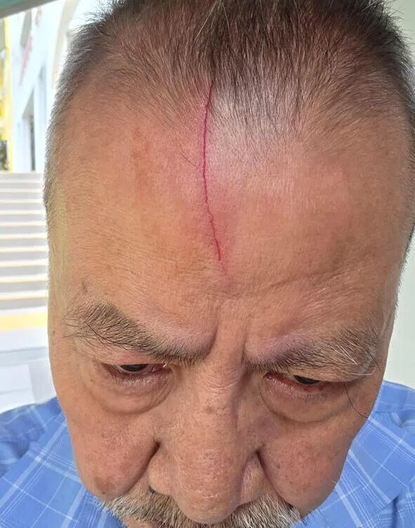 附近居民黄先生额头处被乌鸦抓出一道长达8公分的伤口。（受访者提供）