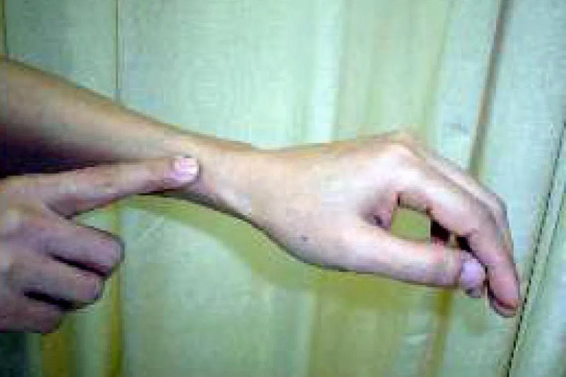 列缺穴：在前臂桡侧缘，桡骨茎头上方，腕横纹上1.5寸。（档案照）