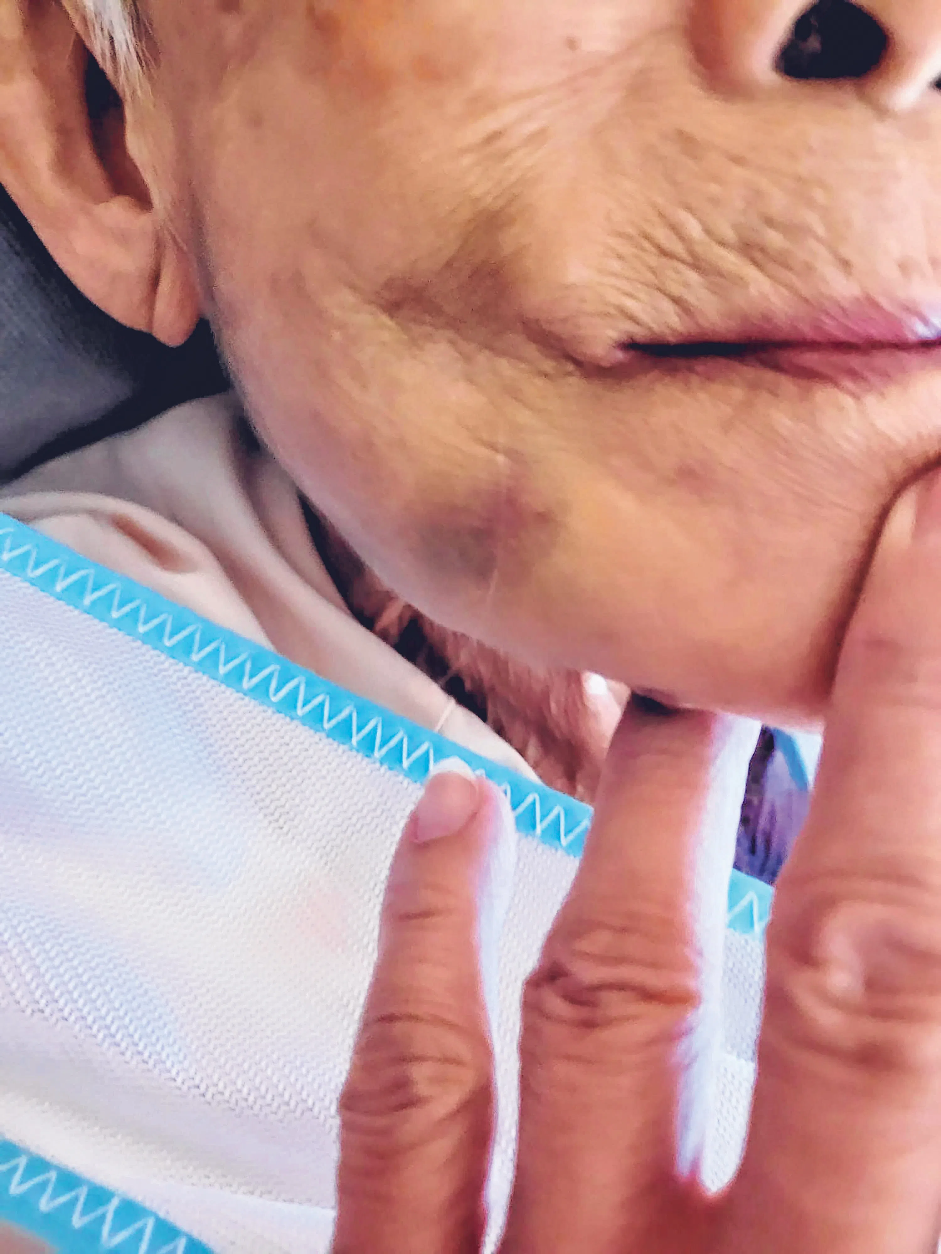 90岁老妇的下巴与四肢事后出现淤青。（受访者提供）