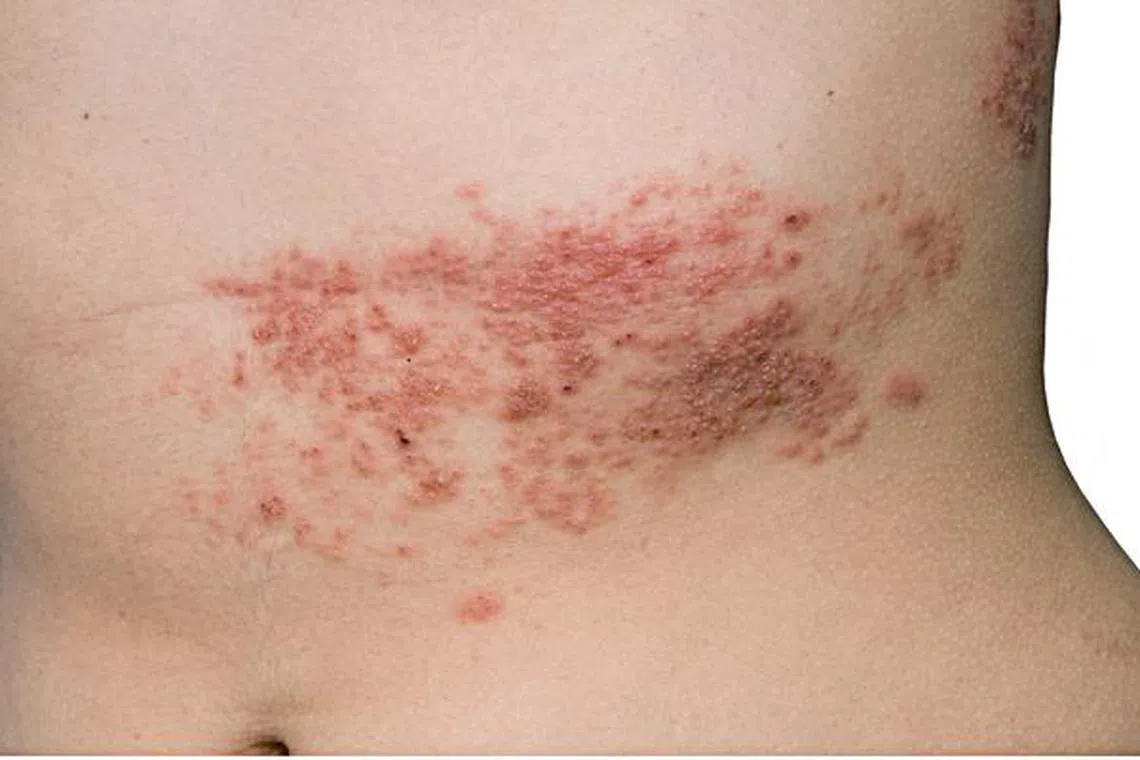 带状疱疹最常见的部位包括腰间、背部。（档案照）