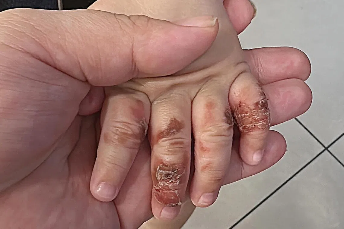 受害男童的手之前曾被热粥烫伤。（受访者提供）