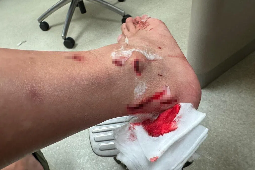 浴室玻璃突爆裂 孕妇脚割伤溅血