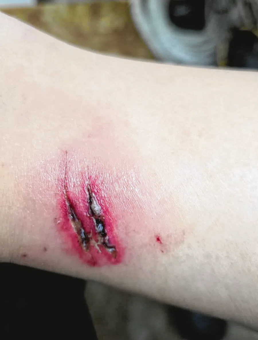 杨女士的伤口事后发炎和灌脓。（受访者提供）