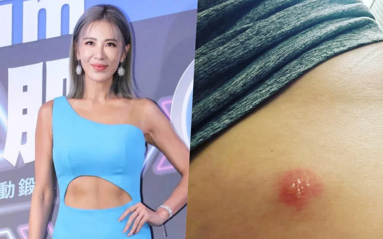 小祯身体抱恙，日前才自揭患上带状疱疹，现在又因严重B型流感入院。（互联网、取自小祯IG（右图））