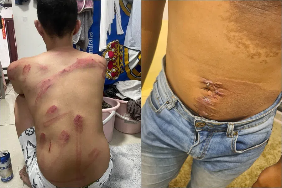 一些受害者因试图逃出园区，结果遭诈骗团伙虐打。（受访者提供）