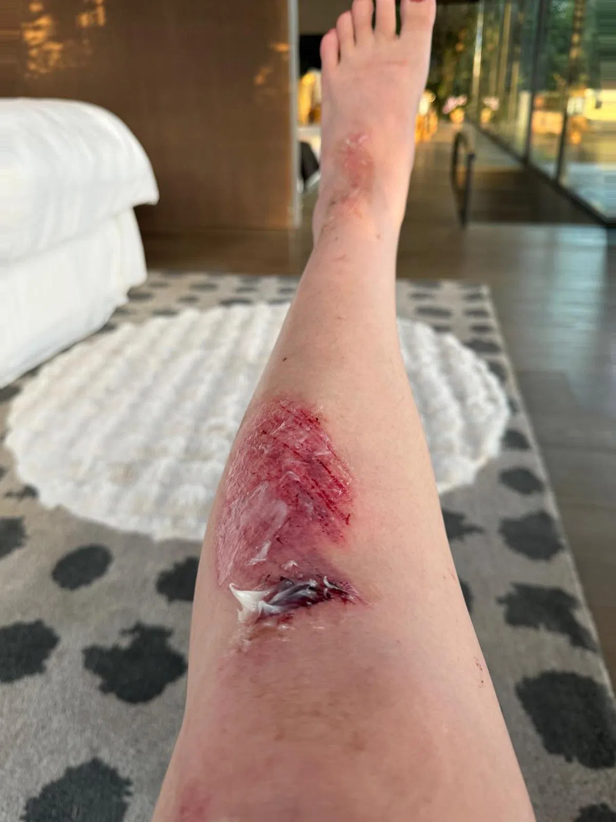 陈文茜散步时不慎摔倒伤及膝盖和小腿。（取自陈文茜脸书）