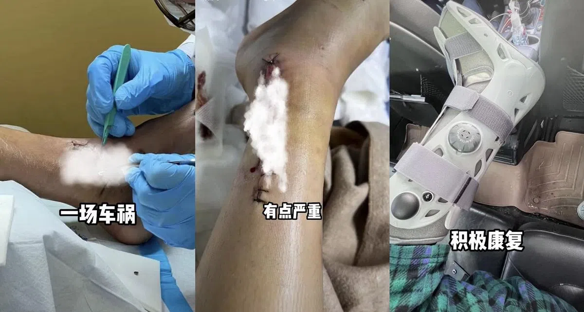 陈学冬因车祸而导致腿部受伤。（互联网）