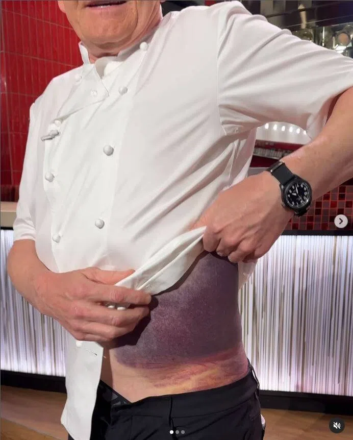 戈登在IG影片中露出左腹一大片紫色瘀青，模样相当吓人。（互联网）