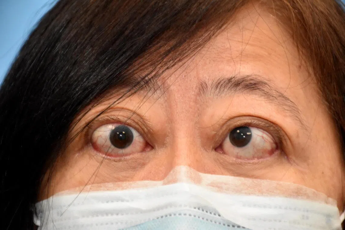 吴女士曾患上甲状腺眼病，导致眼睛肿胀斜视。（国立大学医学组织提供）