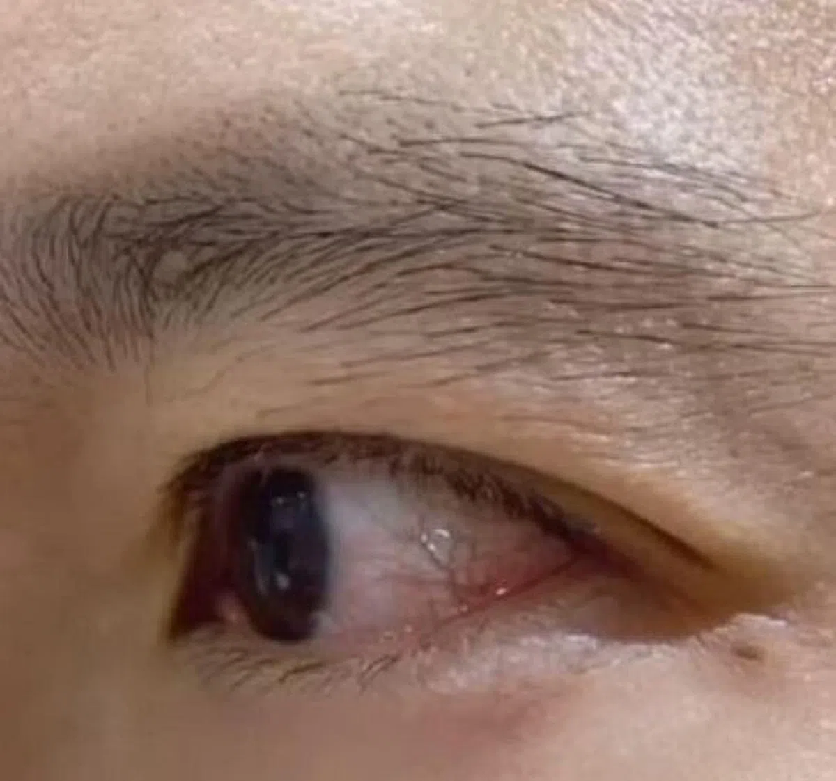 立威廉左眼视网膜脱落。（图取自面簿）