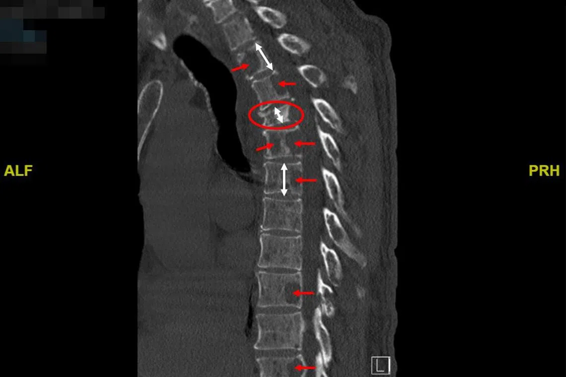 王明星的电脑断层扫描（CT Scan）显示，有多个空洞（红色箭头）分散在他的脊柱。（取自法庭文件）