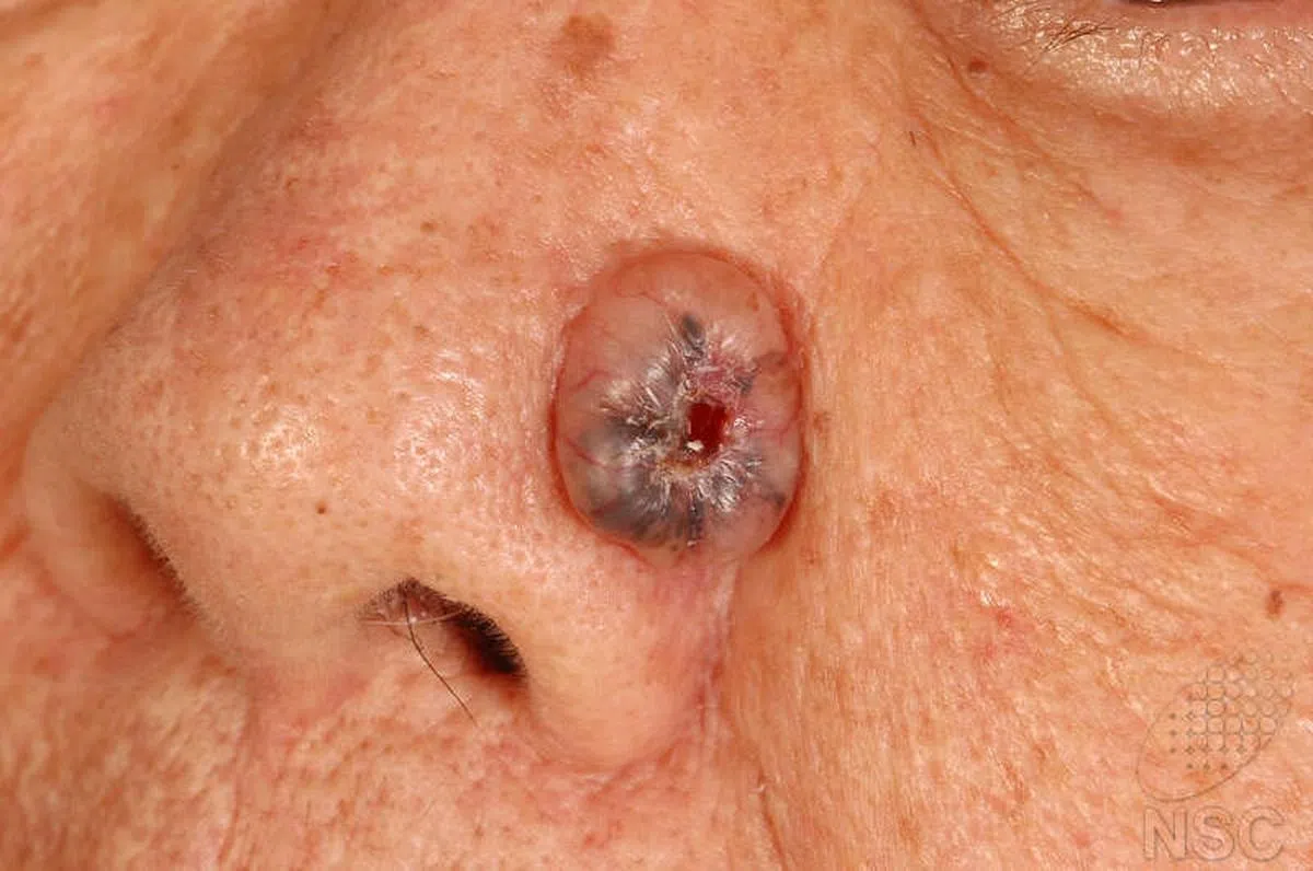 基底细胞癌。（ 图／全国皮肤中心）