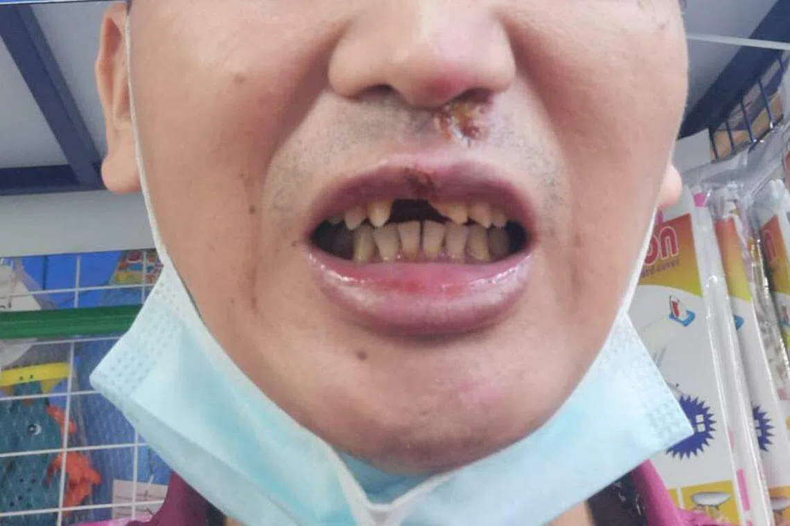 林先生星期三（12月20日）告诉《联合早报》记者，他的伤势目前正在恢复中，后续还须要去医院植牙（受访者提供）