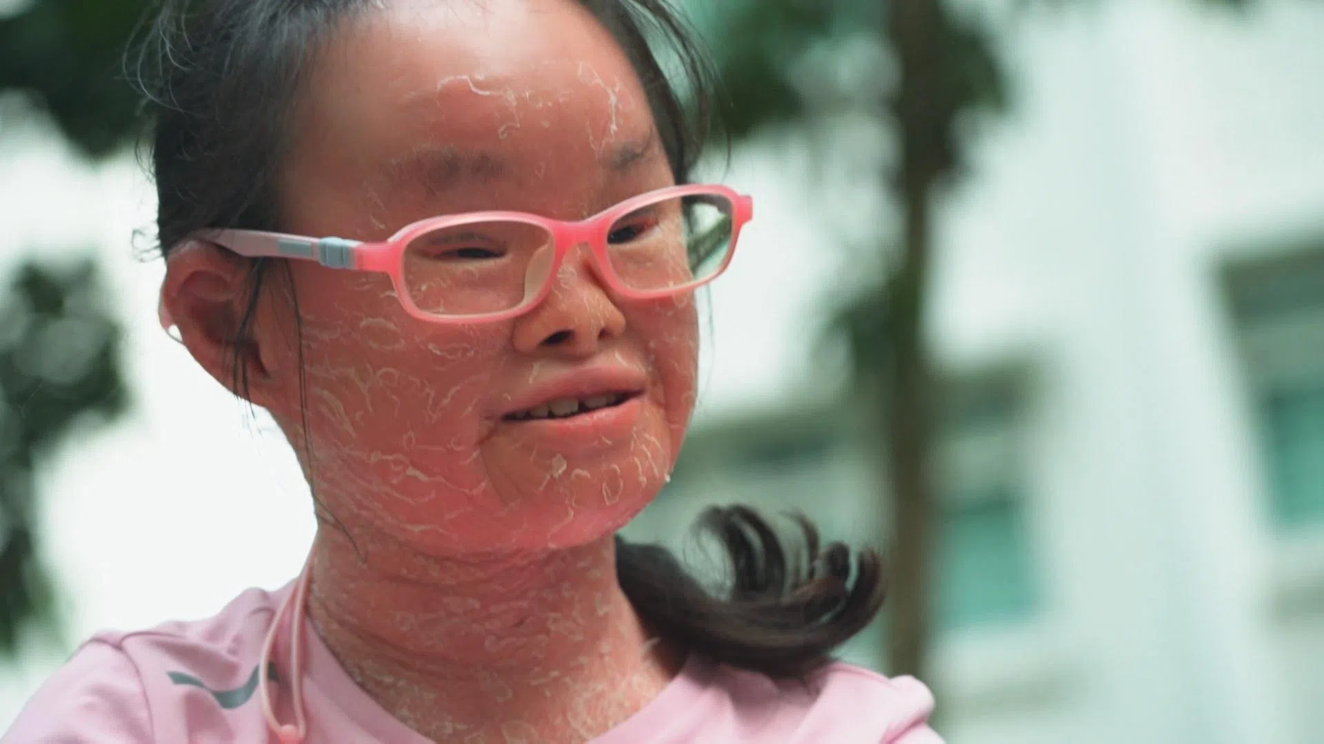 吴凯歆患有鱼鳞症且无手掌，但她非常乐观坚强的生活着。（新传媒提供）