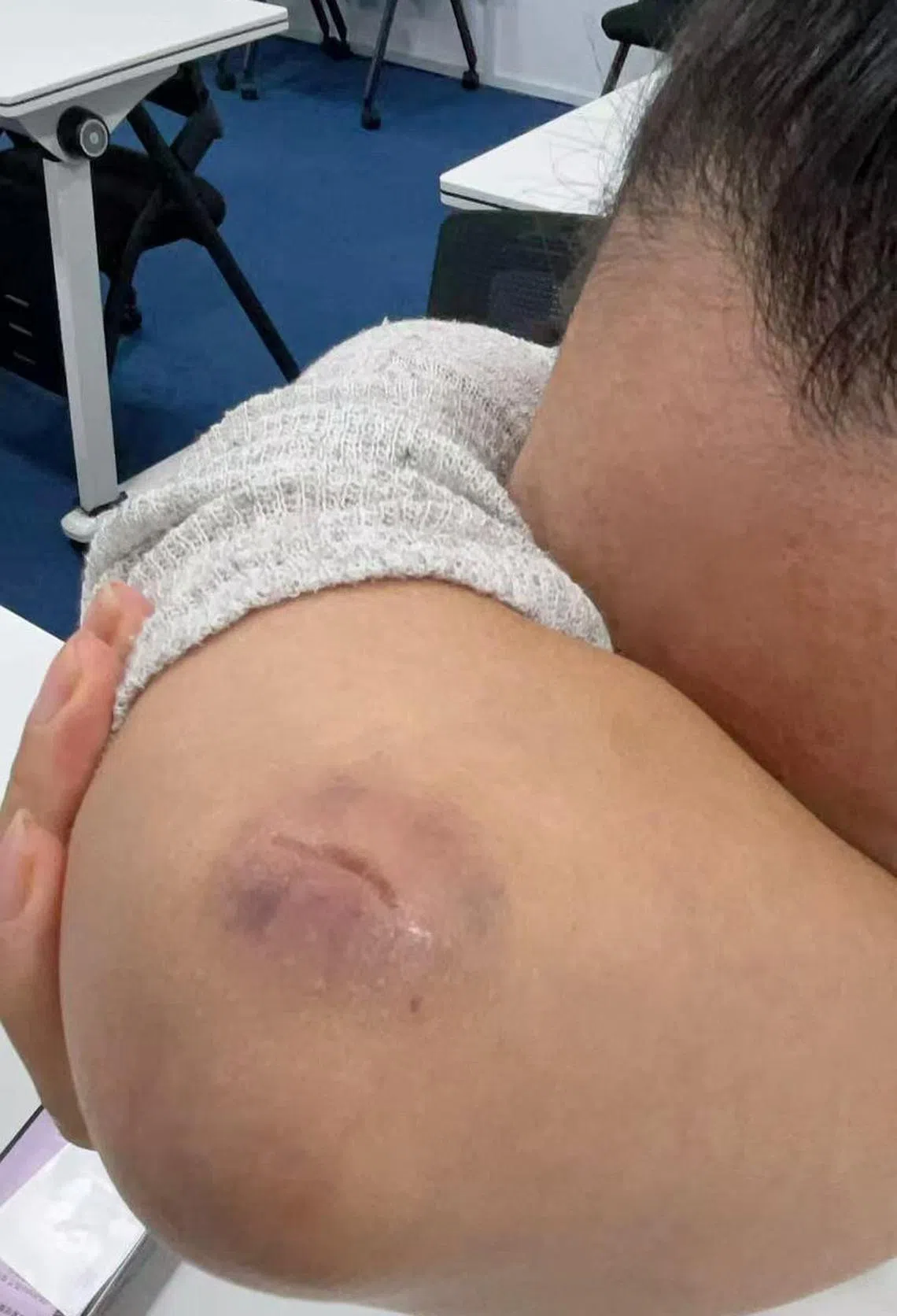 赵小姐右手臂被咬伤。（受访者提供）