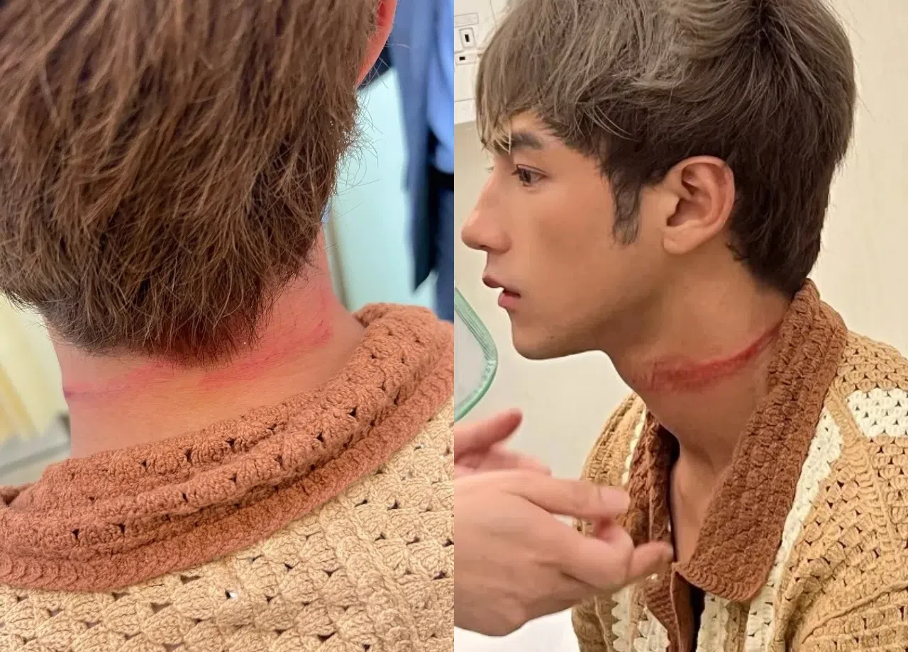 魏浚笙在社媒上载多张受伤的血痕照，吓坏粉丝。（取自魏浚笙IG）