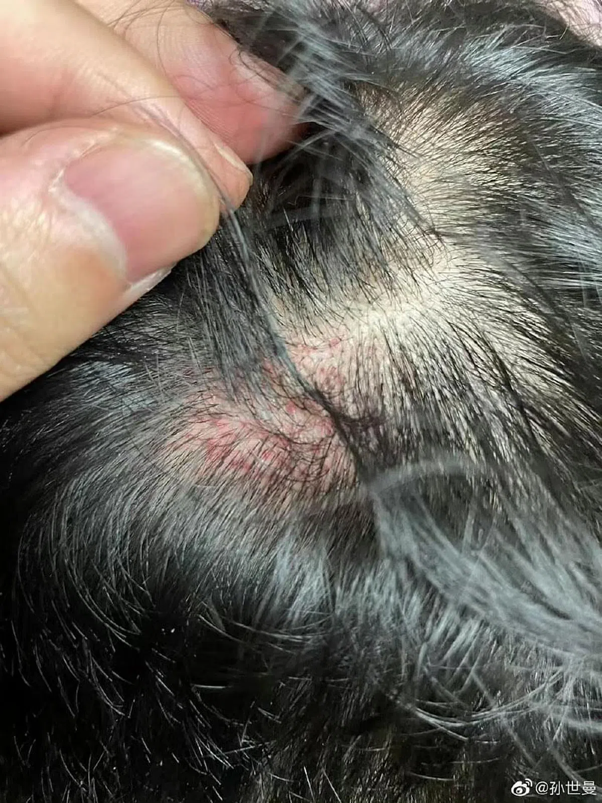 被打的中国留学生头皮受伤。（微博）