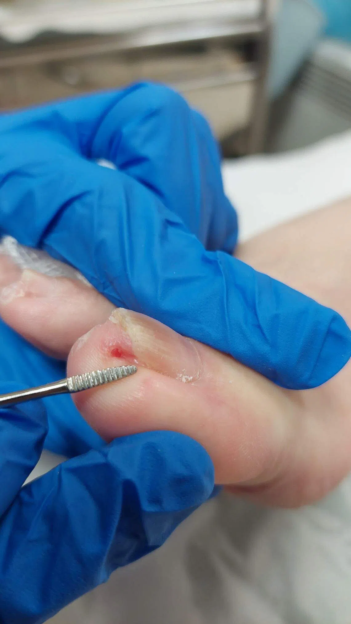 足部诊疗师会使用经过无菌处理的专业器具处理内嵌趾甲，避免引起脚趾感染。（新加坡保健服务集团综合诊疗所提供）